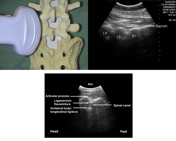 longitudinal paramedian approach