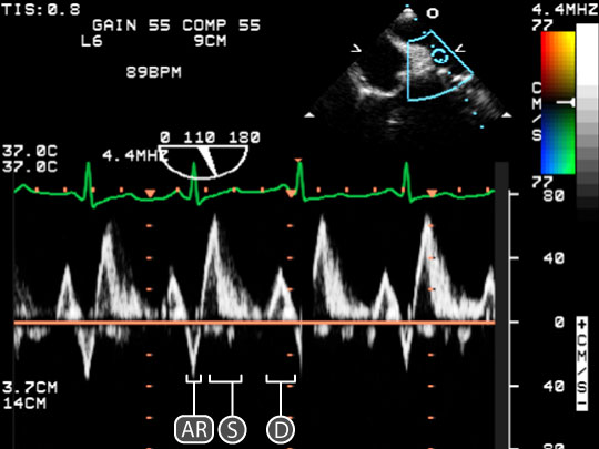 pulse wave spectral Doppler of Right Pulmonary Vein